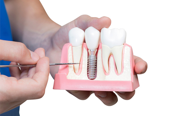 ¿Existen beneficios en los implantes dentales? Conoce las ventajas de la cirugía dental
